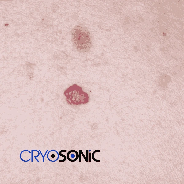 Looking for pain free cherry angioma removal treatment Brackley? Call our team today! Brackley