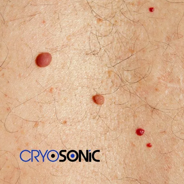get cherry angioma removal treatment today! Brackley