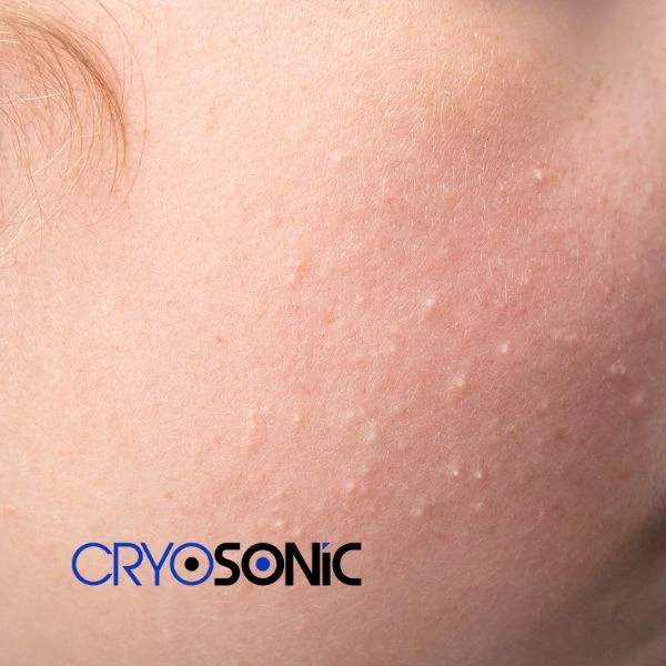 Are you looking for milia removal treatment? Contact our team today Brackley