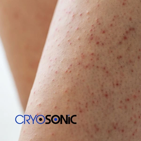Looking for Seborrhoeic Keratosis removal Brackley treatment? Call our consultants today in Brackley