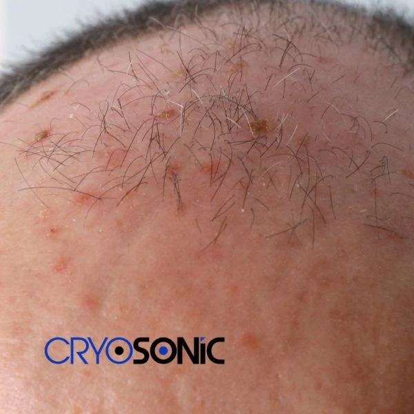 Access Seborrhoeic Keratosis removal from the comfort of your own home! Call us today in Brackley