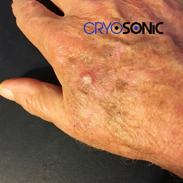 Understand more about actinic keratosis treatment today Brackley