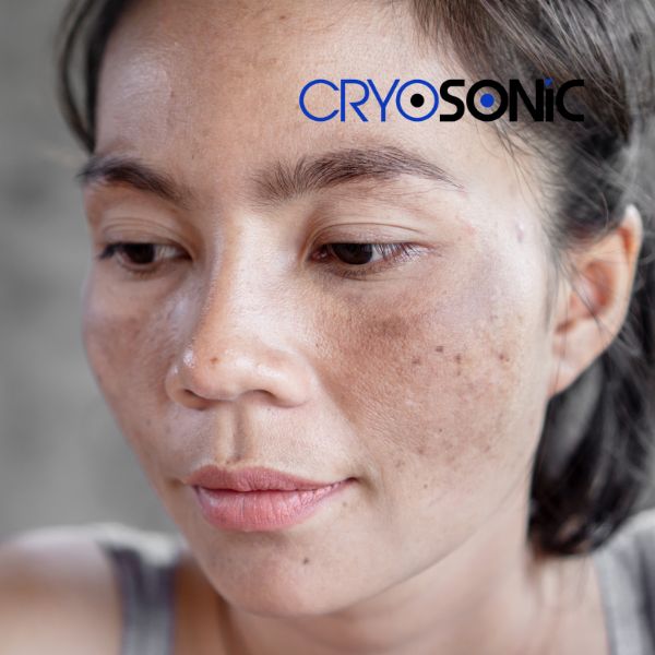 Ready to start age spots removal? Contact our team today in Brackley