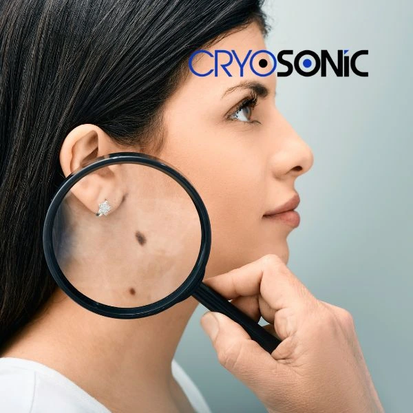 Do you want to learn more about benign moles removal treatment? Call our team today Brackley