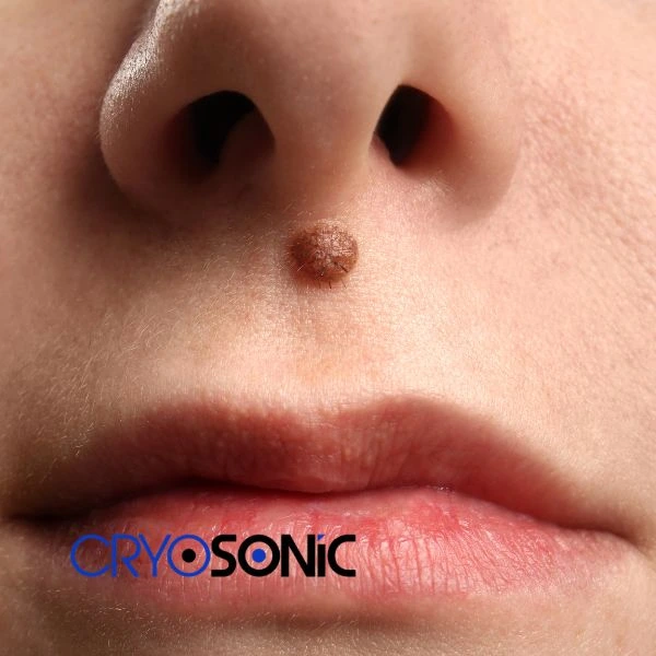 Start your benign moles removal treatment today Brackley