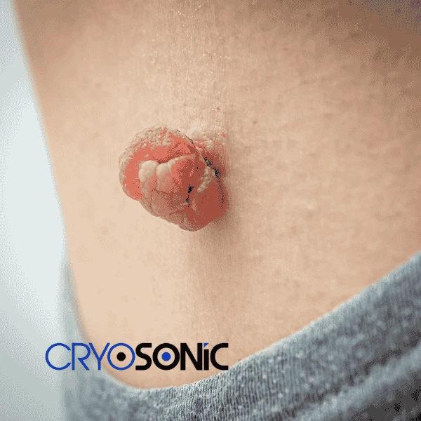 Book your skin tags removal Brackley from comfort of your own home! Brackley