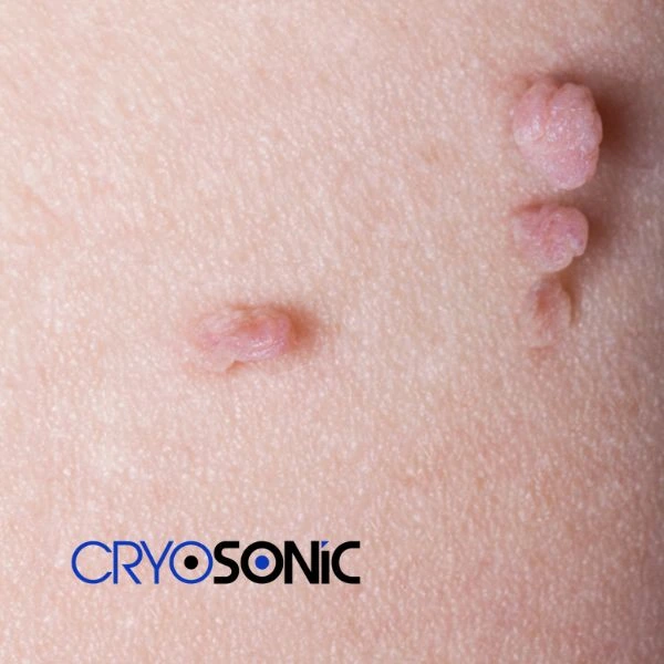 Are you looking for fast effect skin tag removal Brackley? Book in NOW! Brackley