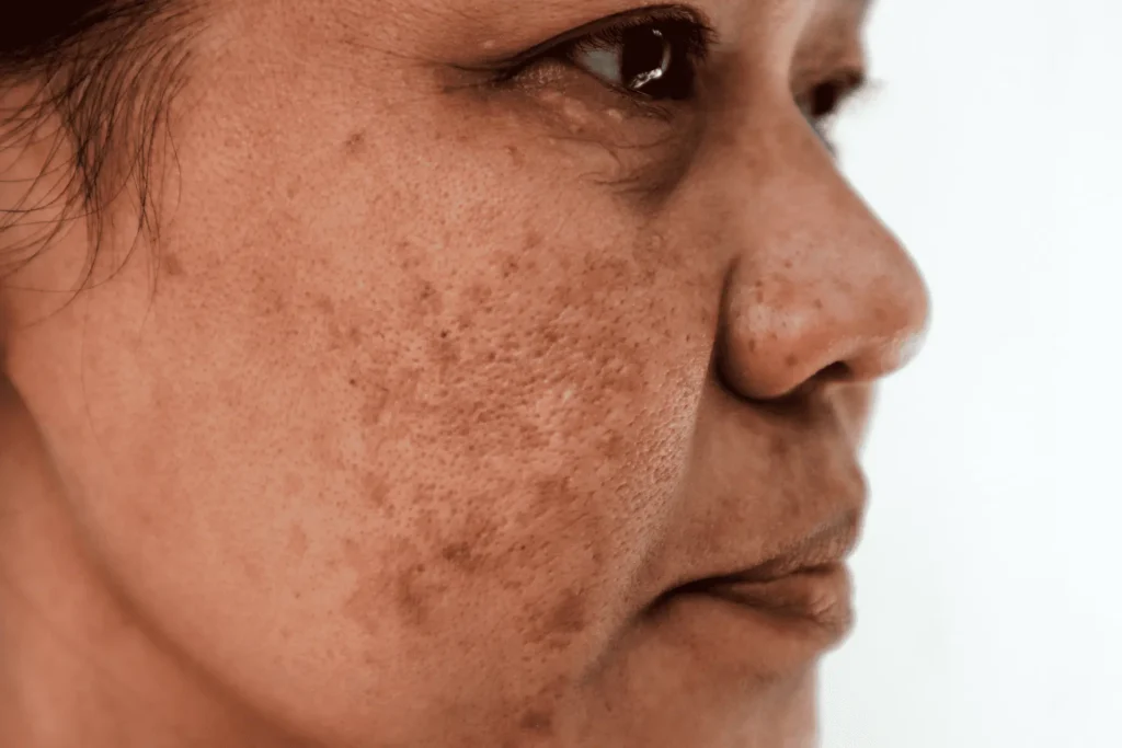 Cryosonic Repair Sun-Damaged Skin Brackley Brackley