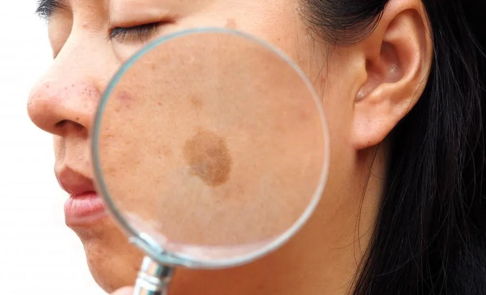 How Seborrheic Keratosis Brackley appears on the skin Brackley