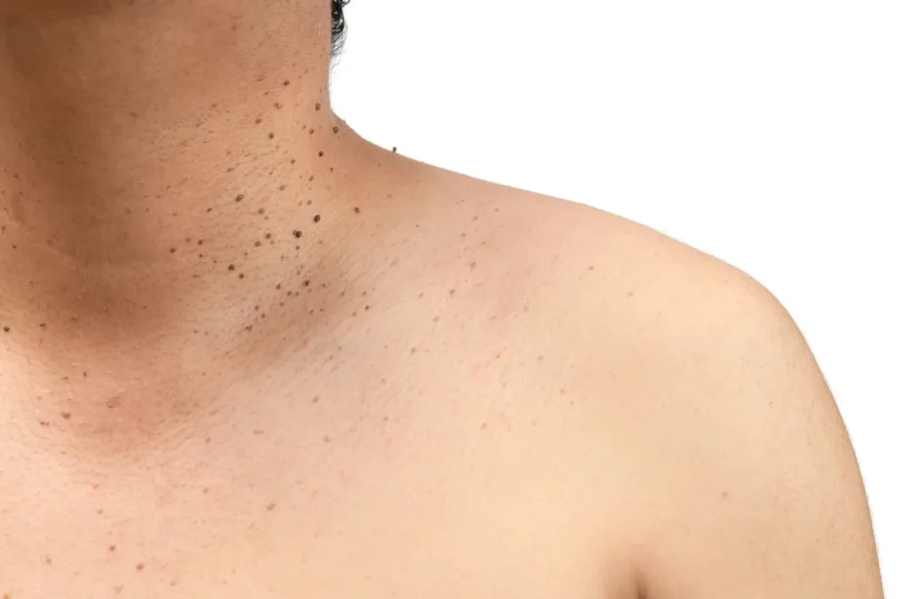 How to Maintain Healthy Skin After Treatment Brackley? Brackley