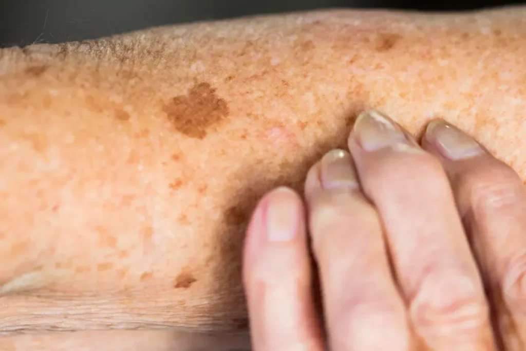Why Is Early Treatment of Sun Damage Important Brackley? Brackley