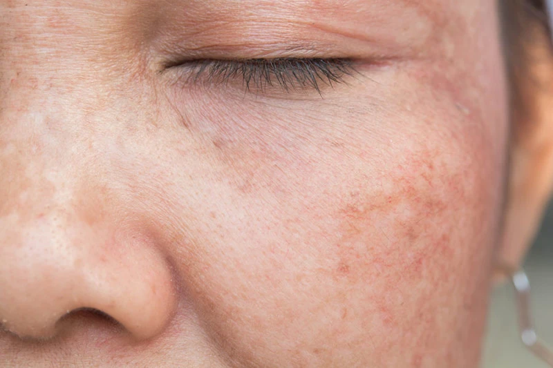 UV rays affecting skin cells, showing sun damage and the need for Cryosonic repair treatments Brackley. Brackley