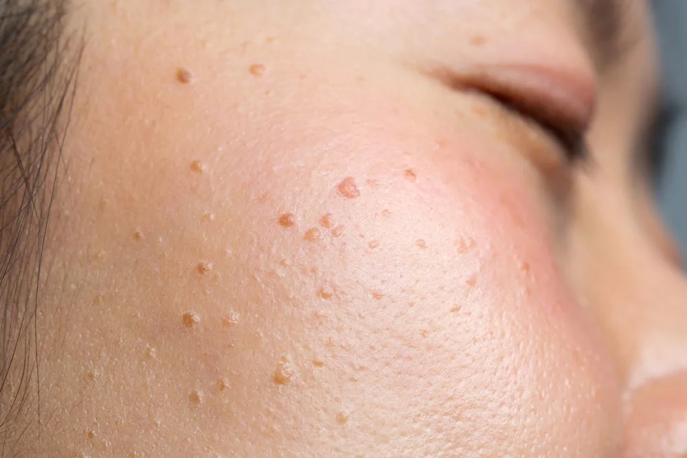 Why Choose CryoPen for Seborrheic Keratosis Brackley Brackley